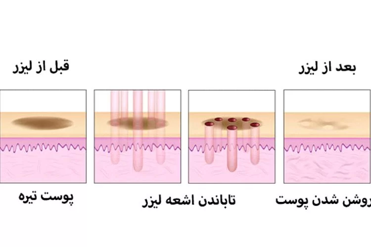 سفید کردن واژن با لیزر